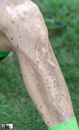 Taylor's messed up leg